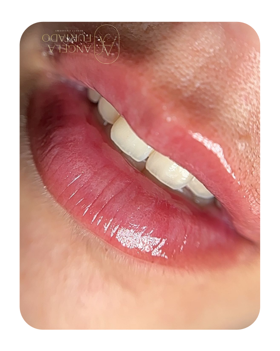 Tratamento Hydragloss para lábios