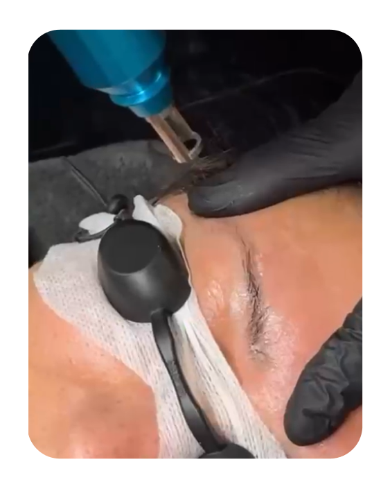 Remoção tatuagem